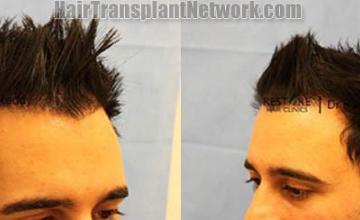 Hair transplantation surgery before and after images