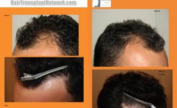 Hair transplantation surgery before and after photos