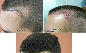 Hair transplantation surgery before and after photos