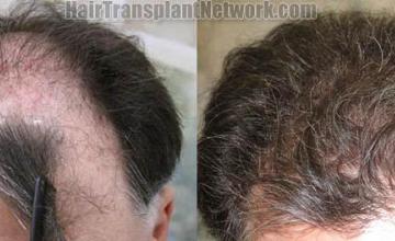 op view - Before and after surgical hair replacement