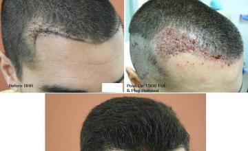 Hair restoration procedure before and after results