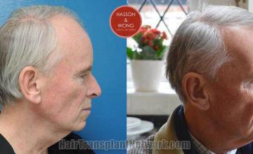 Hair transplantation surgery before and after pictures