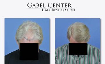 Hair restoration procedure before and after pictures