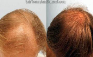 Hair transplantation surgery before and after images