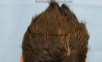 Hair transplantation surgery before and after pictures