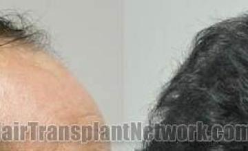 Hair transplantation surgery before and after images