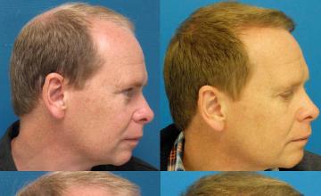 Hair transplantation surgery before and after images