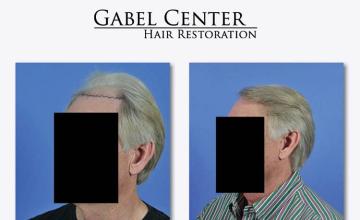 Hair restoration surgery before and after images