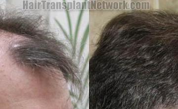 Hair transplantation surgery before and after pictures