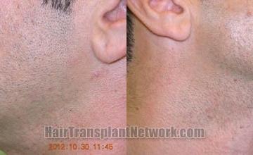 Hair restoration procedure before and after pictures