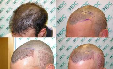 hair transplantation surgery before and after images