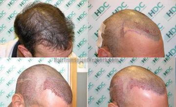 Hair transplantation surgery before and after photos