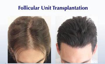 Hair transplantation surgery before and after images