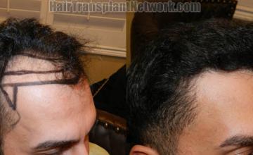 Hair transplantation surgery before and after photos