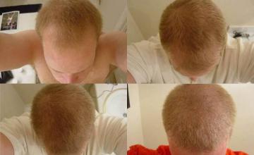 Top view before and after hair restoration