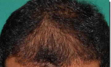 Hair restoration procedure results