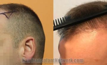 Hair restoration procedure before and after pictures