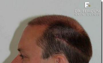 Hair restoration procedure results