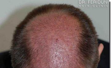 Hair restoration procedure results