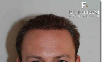 Hair restoration procedure results