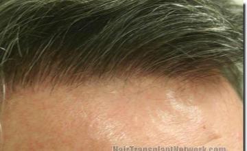 Hair restoration procedure results