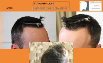 Hair restoration surgery before and after photos