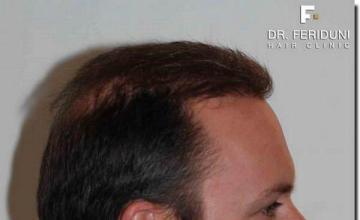 Hair restoration procedure results