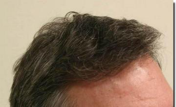 Hair restoration procedure results