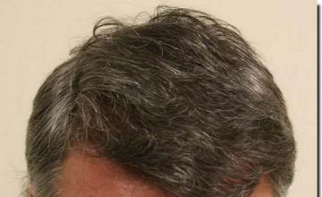 Hair restoration procedure results