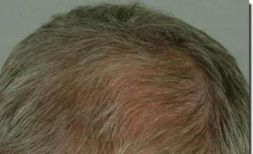 Hair restoration procedure results