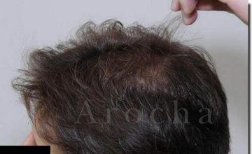 Hair restoration procedure results