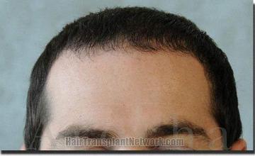 Hair restoration procedure results