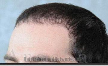 Hair restoration procedure results