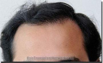 Hair restoration procedure results