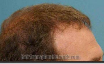 Hair restoration procedure results