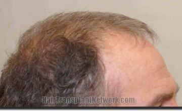 Hair restoration procedure results