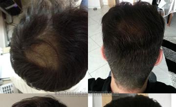 Hair restoration procedure before and after pictures