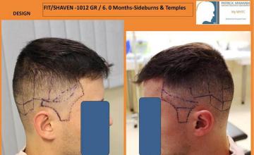 Hair transplantation surgery before photos