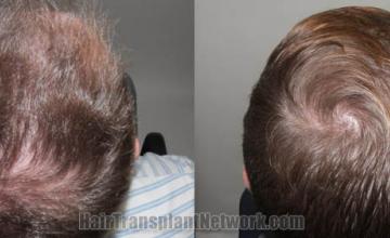 Top view - Before and after surgical hair replacement