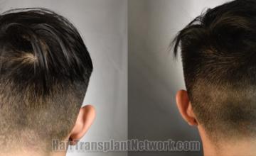 Back view before and after hair transplantation 