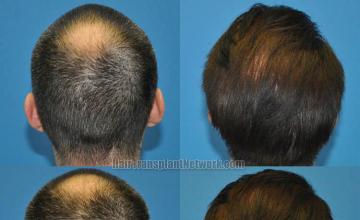 Hair transplantation procedure before and after photographs