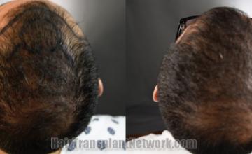 Back view before and after hair transplantation 