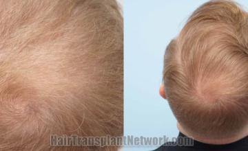 Top view - Before and after surgical hair replacement