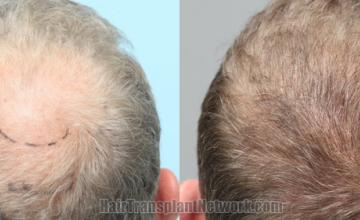 Back view before and after hair transplantation 