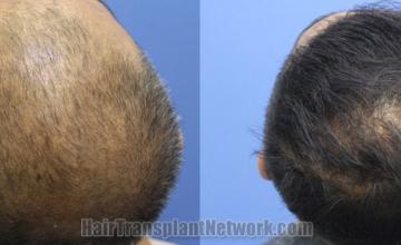 Back view before and after hair transplantation 