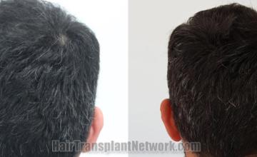 Back view before and after hair transplantation 