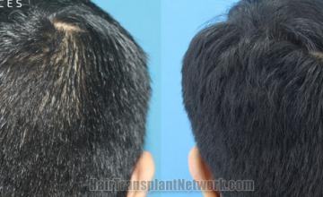 Back view before and after hair transplantation 