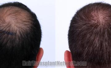 Back view before and after hair transplantation 