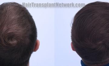 Back view before and after hair transplantation 