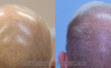 Back view before and after hair transplantation 